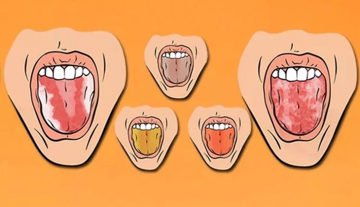 Dilinizin rengi ne olmalı?