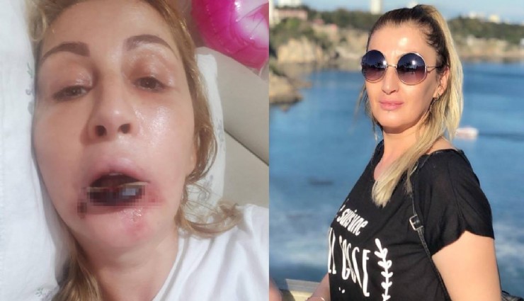 Estetik işlem sonrası dudağı çürüdü, 7 yıldır hukuk mücadelesi veriyor