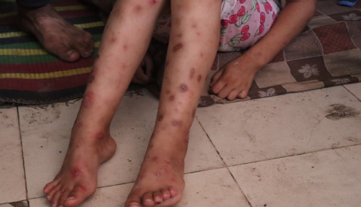 Gazze'de suçiçeği alarmı: İki haftada 9 bin 300 vaka